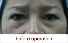 plastic-surgery-blepharoplasty